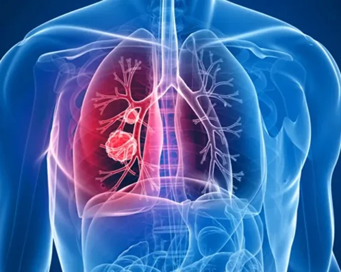 cancer pulmonjpg